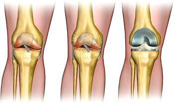 ACL surgery in Delhi, India