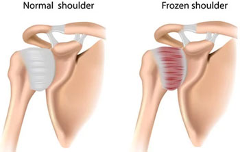 Frozen Shoulder Treatment in Delhi