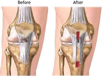 PCL Surgery in Delhi